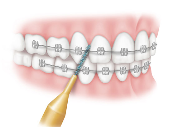 Interdentalbuerstchen