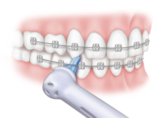 Elektrische Zahnbuerste